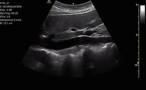 IVC.gif