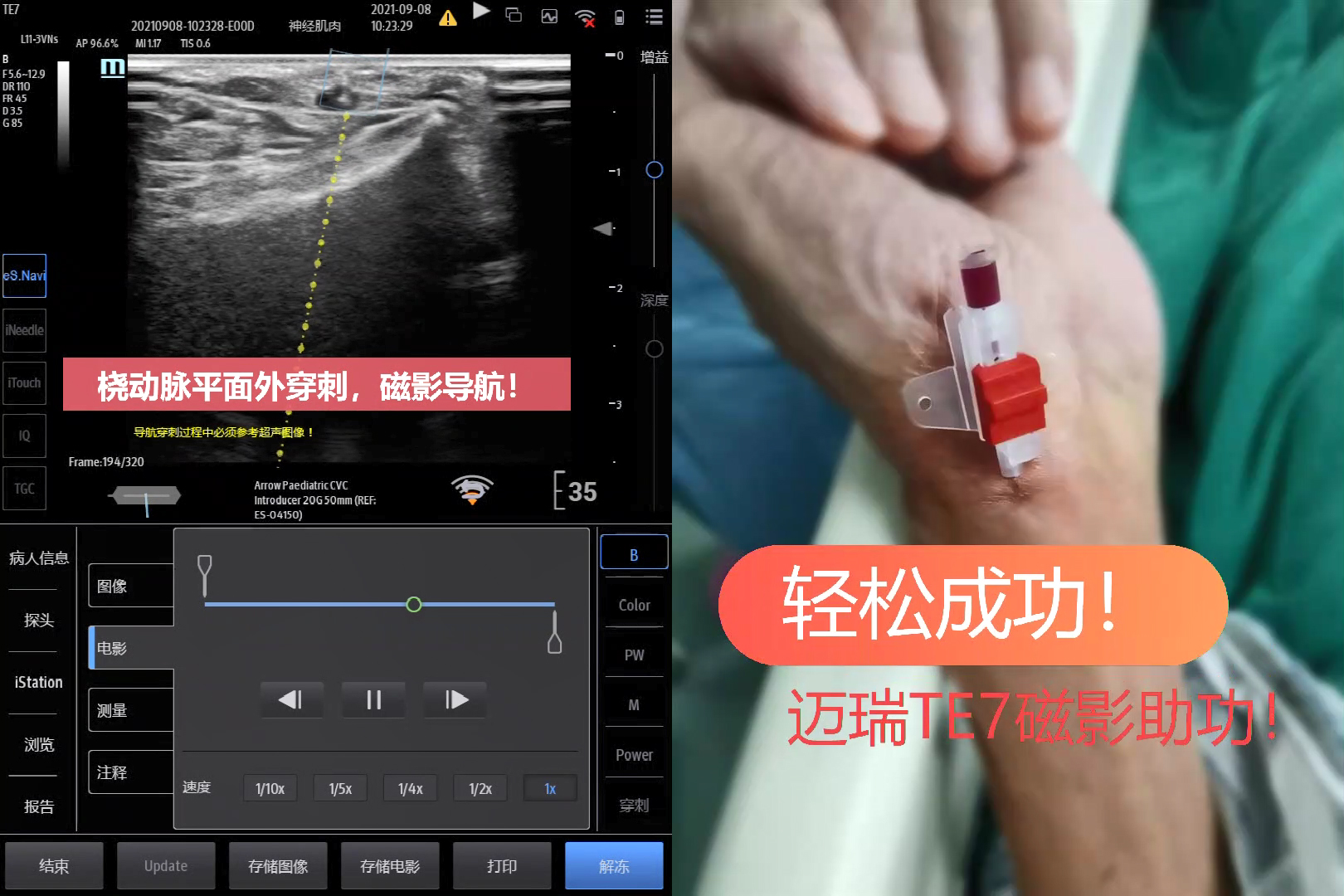 桡动脉穿刺磁影导航[00_00_08][20210915-234140].jpg
